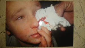 Steve Ansford permitted No Fibs to use this image of his son Dusty suffering a nosebleed, which the Ansfords say have become frequent since CSG operations began in their local area. 